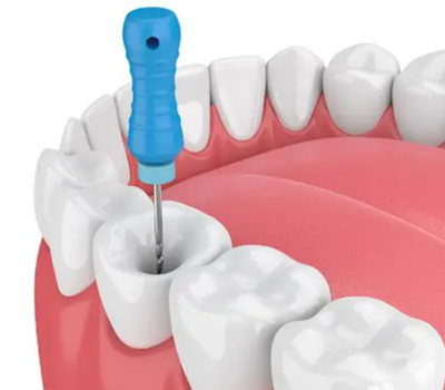 Root Canals